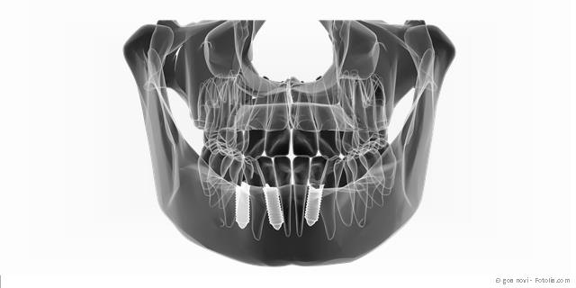 3D-Navigation zur Vermeidung von Risiken bei der Implantation 3D-Navigation zur Vermeidung von Risiken bei der Implantation