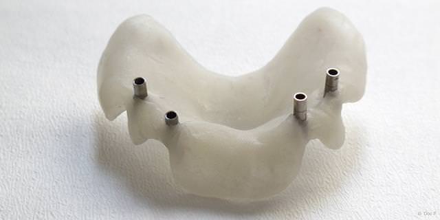 Bohrschablone für exakte Implantat-Positionierung Bohrschablone für exakte Implantat-Positionierung