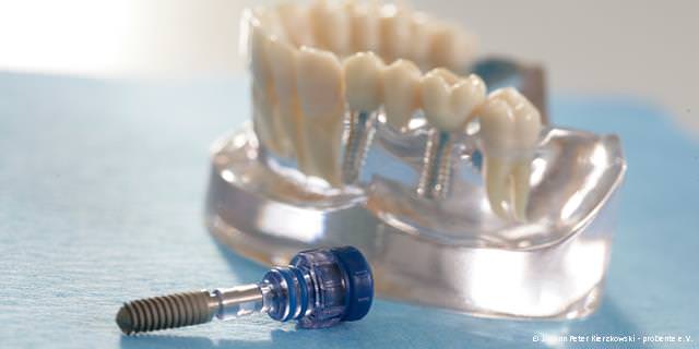 Moderne und zertifizierte Implantat-Systeme Moderne und zertifizierte Implantat-Systeme