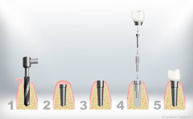 Die meisten Implantate werden im sog. zweiphasigen Verfahren eingesetzt.