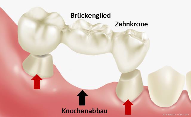 Zahnlücke: Für eine Zahnbrücke müssen (oft gesunde) Nachbarzähne abgeschliffen werden. Zahnlücke: Für eine Zahnbrücke müssen (oft gesunde) Nachbarzähne abgeschliffen werden.