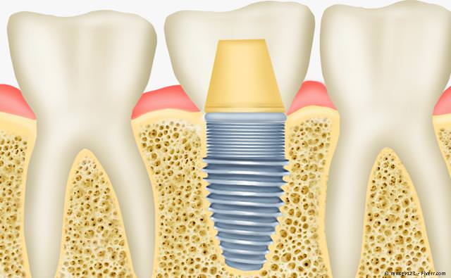 Beim Lückenschluss mit einem Implantat bleiben die Nachbarzähne verschont. Beim Lückenschluss mit einem Implantat bleiben die Nachbarzähne verschont.