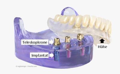 Mit nur wenigen Implantaten pro Kiefer können Zahnprothesen wieder einen festen Halt bekommen.