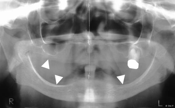 Stark abgebaute Kiefer im Seitenzahnbereich. Der Platz für Implantate ist nicht ausreichend. Stark abgebaute Kiefer im Seitenzahnbereich. Der Platz für Implantate ist nicht ausreichend.