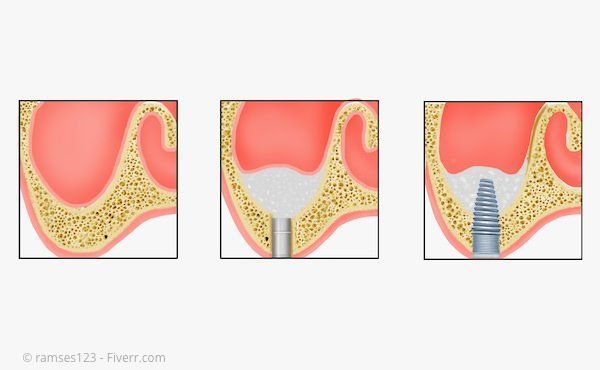 Sinus-Lift: Anhebung des Kieferhöhlenbodens mit Knochen oder Knochen-Ersatzmaterial Sinus-Lift: Anhebung des Kieferhöhlenbodens mit Knochen oder Knochen-Ersatzmaterial