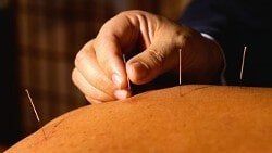 Acupuncture, Rehabilitation Services in Fort Lee, NJ
