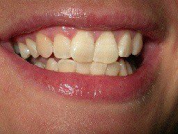 Sbiancamento dentale