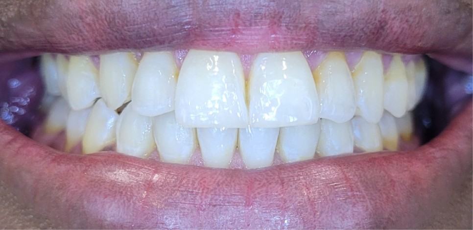 Ottawa Dental Care - Before and after