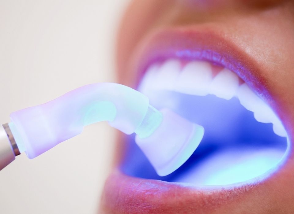 A dental professional uses a blue LED light tool to perform a professional teeth whitening procedure on a patient.