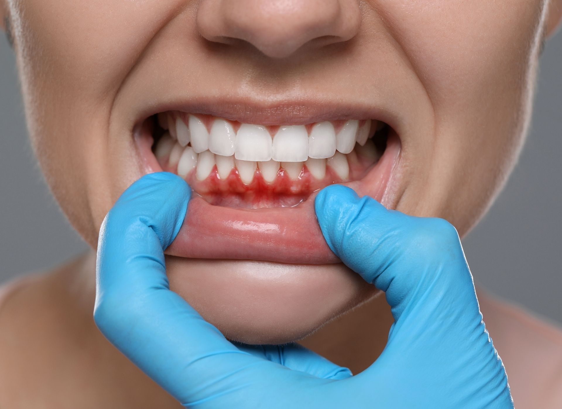 A person in blue medical gloves pulls back their lower lip to reveal inflamed, red, and swollen gums.