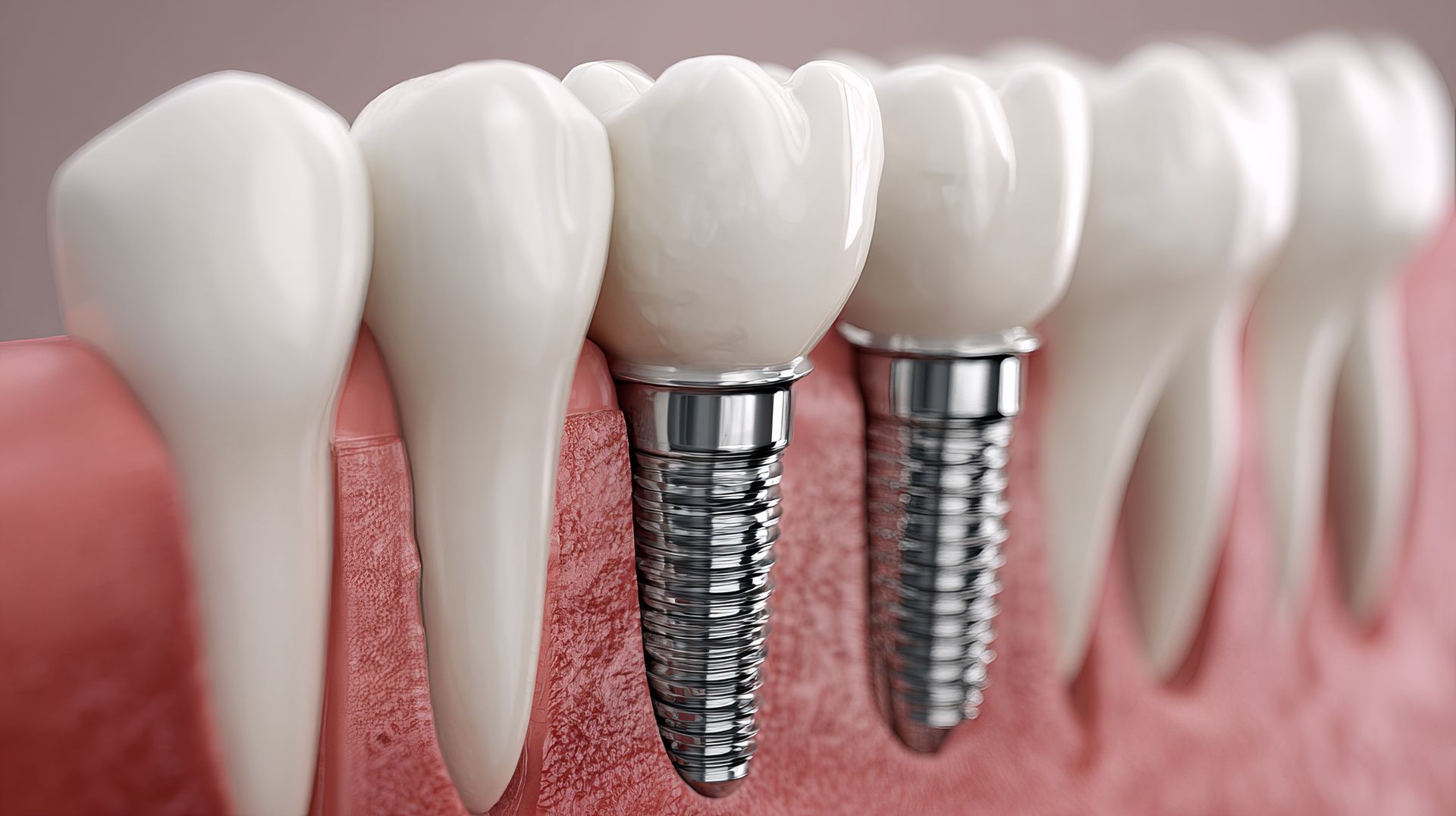 A dental model showing two metallic implants with porcelain crowns embedded in the gum line among natural teeth.