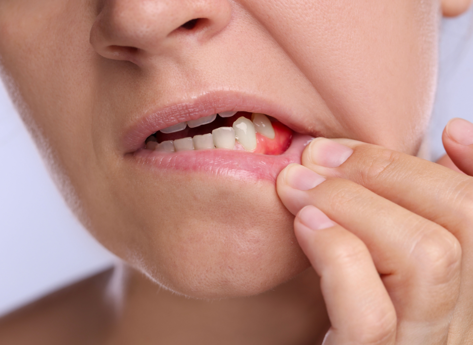 Close-up of a person pulling down their lower lip to reveal inflamed, red gums near their front teeth.