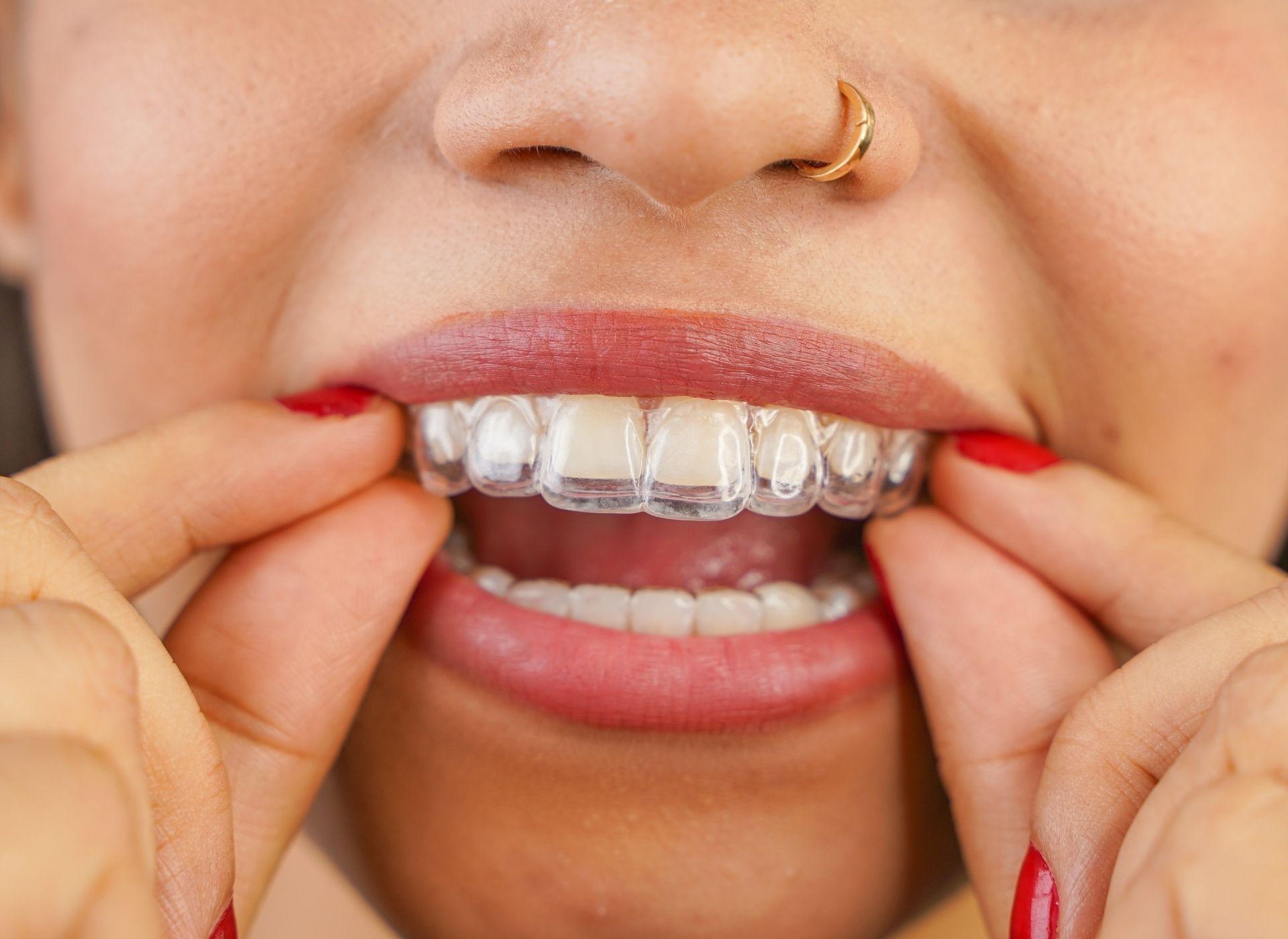 Close-up of a person using their hands to place a clear plastic dental aligner over their top teeth.