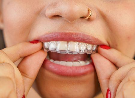 Close-up of a person using their hands to place a clear plastic dental aligner over their top teeth.