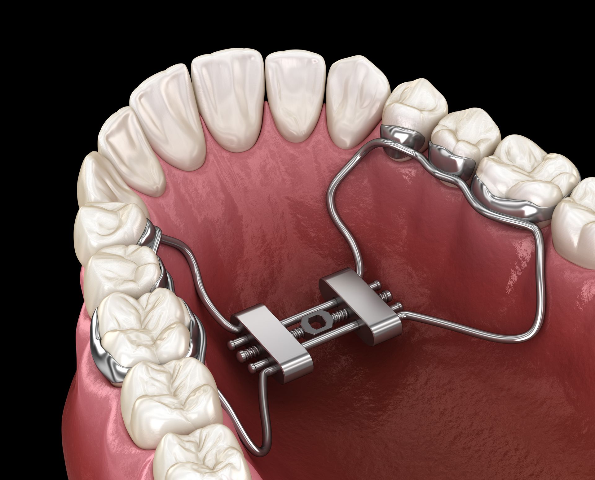 A digital illustration of a metallic orthodontic palatal expander attached to the upper teeth.