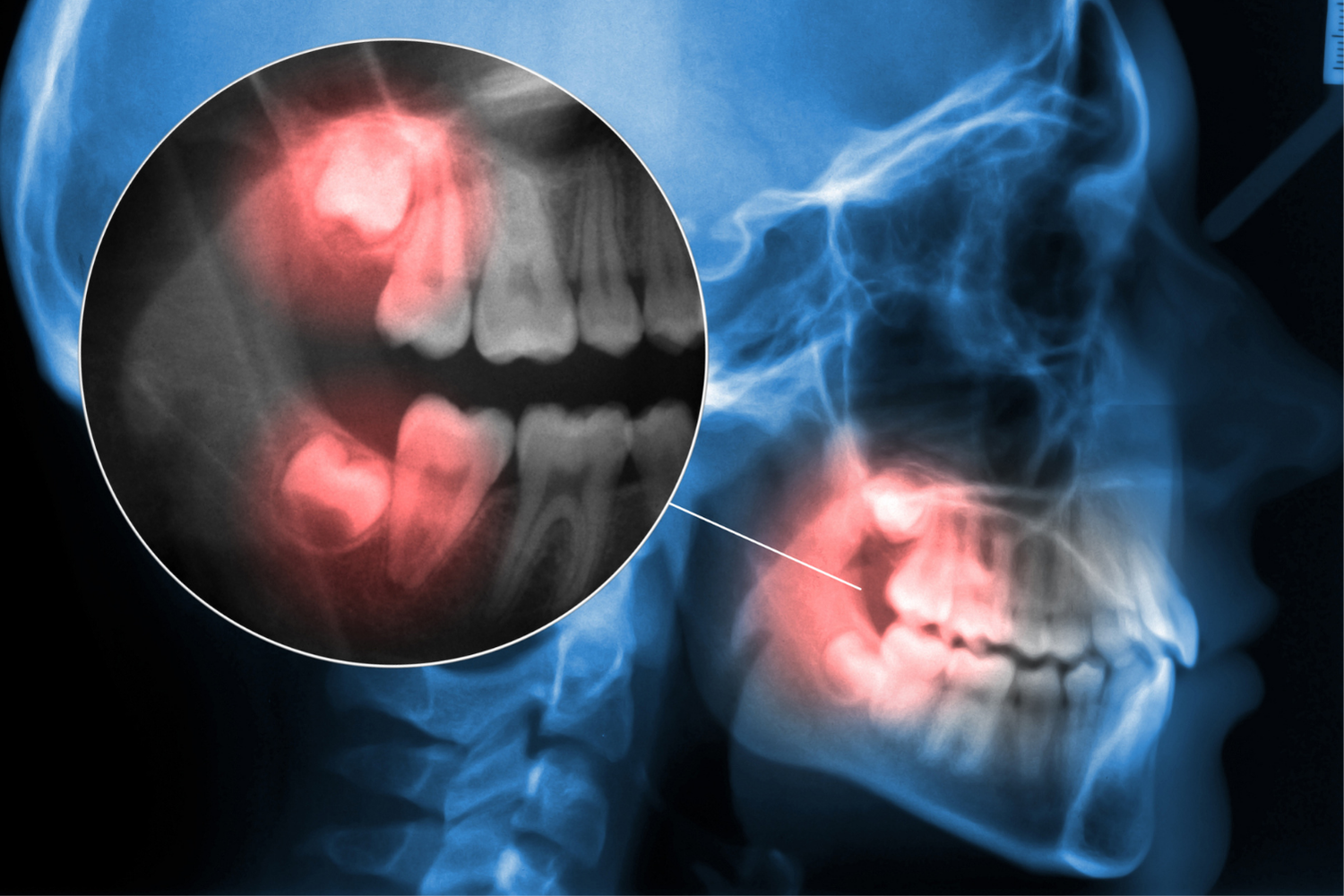 A lateral cephalometric X-ray of a skull, with an inset highlighting impacted wisdom teeth in the jaw highlighted in red.