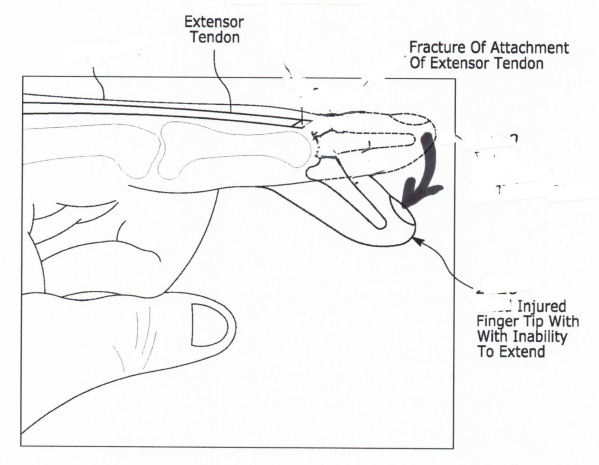 Mallet Finger — Irvine, CA — Perfect Fit Splints