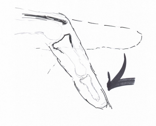 Broken Finger — Irvine, CA — Perfect Fit Splints