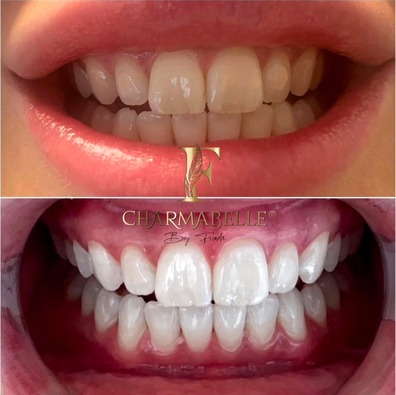 Vor und nach dem Aufhellen der Zähne, für hellere, weißere Zähne.