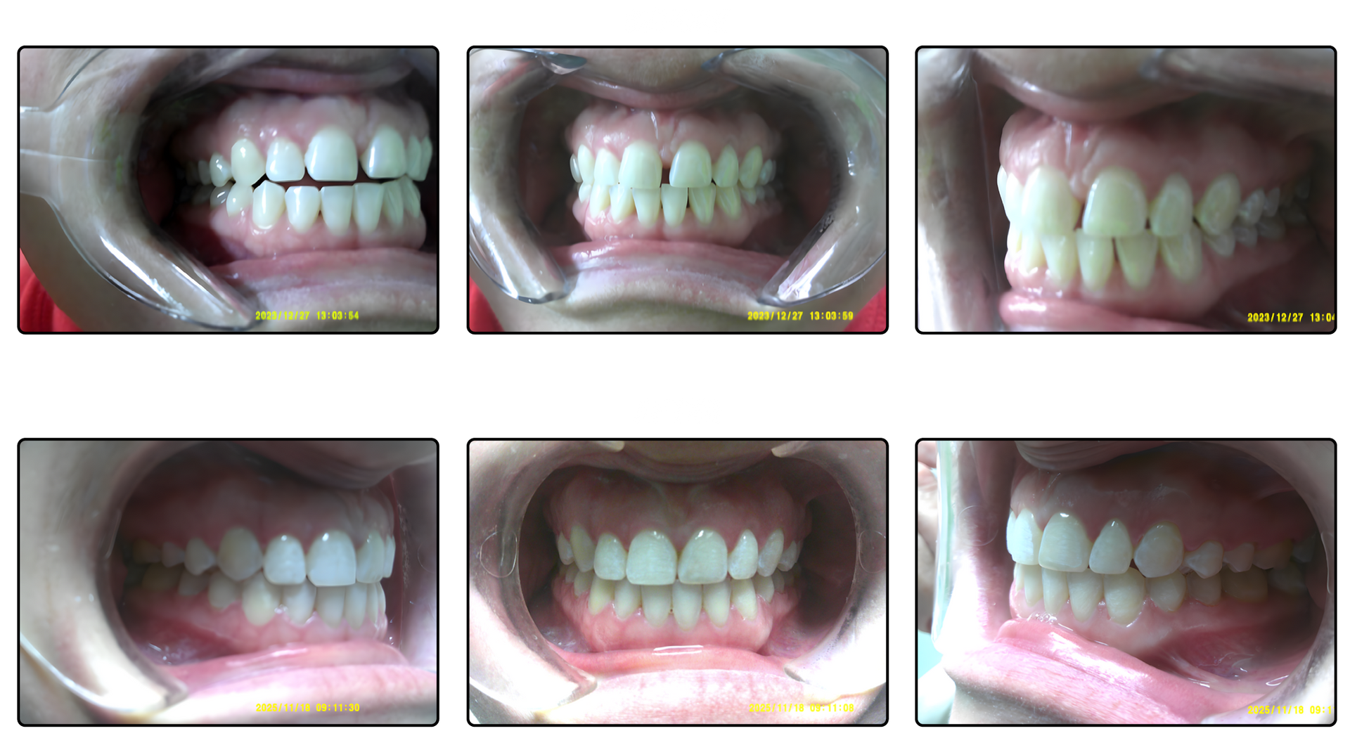 Six close-up views of someone's teeth in a dental exam setting.
