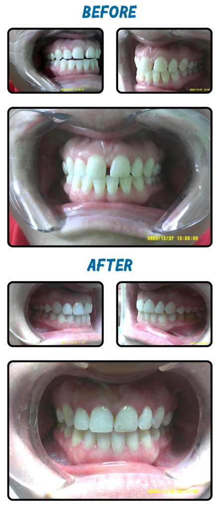 Comparison of teeth before and after dental work. Before, teeth are misaligned; after, teeth are aligned.