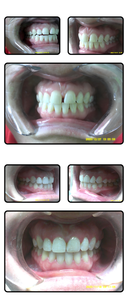Mouth with teeth, various angles of a dental exam.