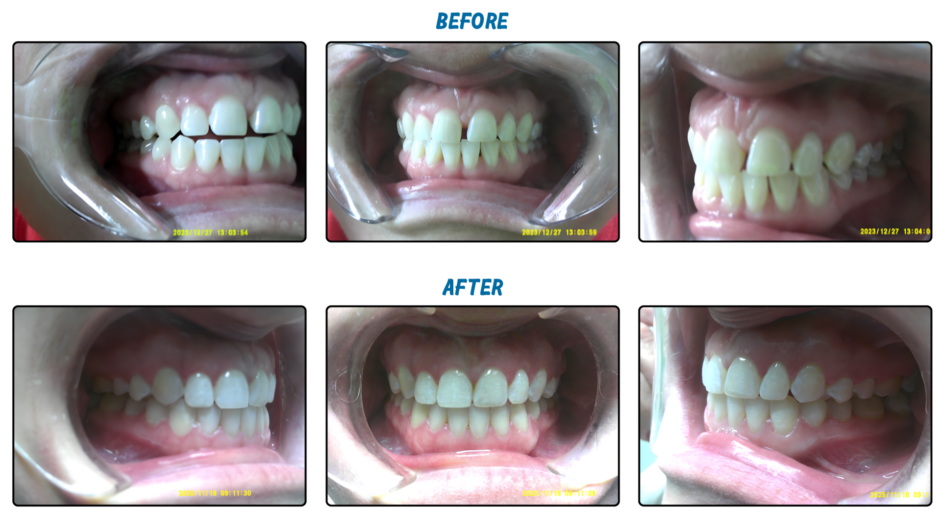 Before/after dental photos showing teeth alignment change, using a mouth retractor.