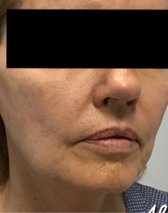 Before And After Photo Northridge And Simi Valley New Skin Laser Center