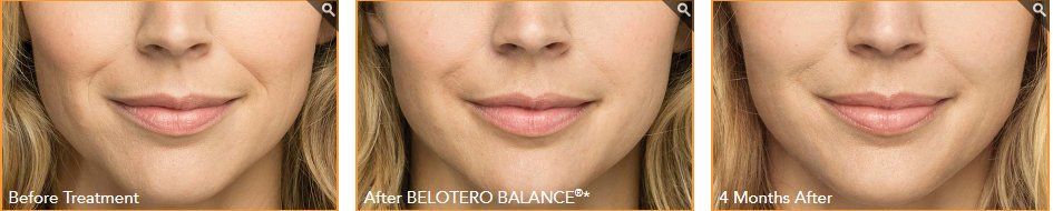 Before After Belotero Treatment - NewSkin Laser Center