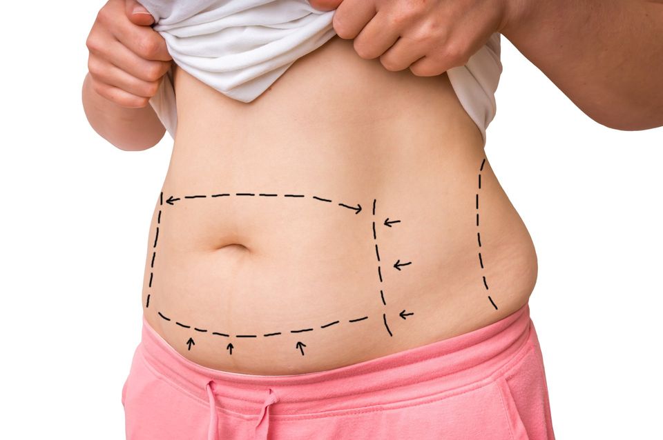 Liposuction Thousand Oaks | Agoura Hills