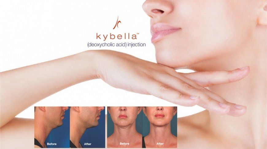Kybella - Double Chin - Simi Valley | Northridge