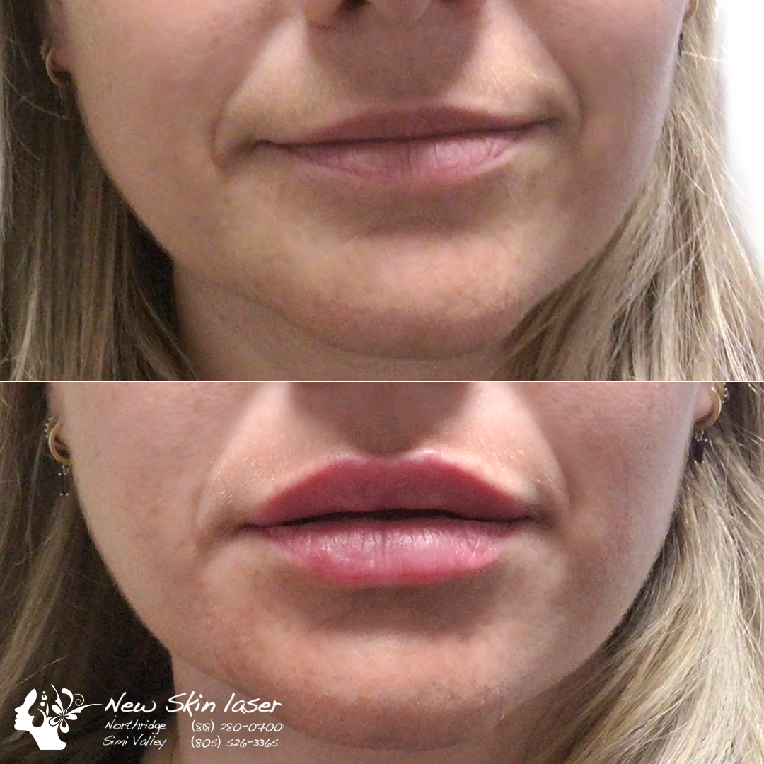 Before And After Photo Northridge And Simi Valley New Skin Laser Center