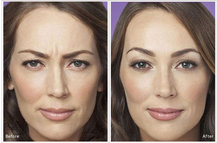 Botox Specials, Rebates and $50 Off