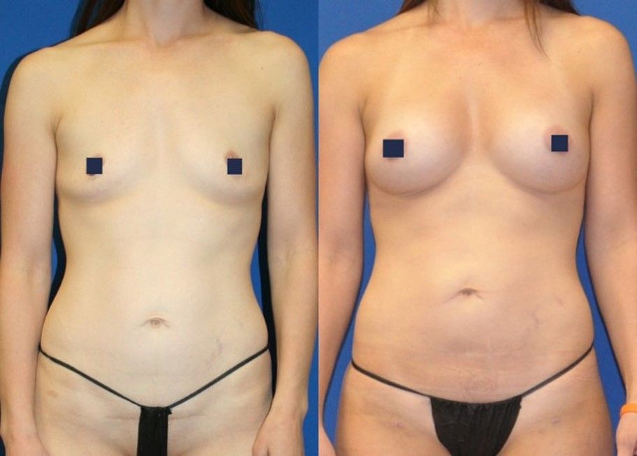 Breast Fat Transfer - Liposuction