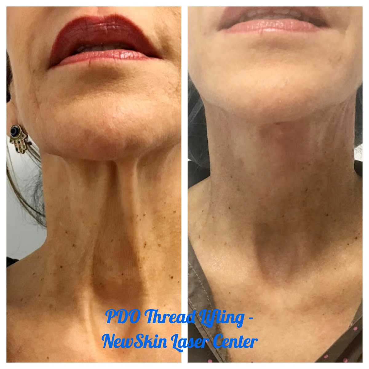 Before And After Photo Northridge And Simi Valley New Skin Laser Center