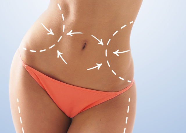 Liposuction - Abdominal Etching & Sculpting Before and After Photo Gallery, Los Angeles, CA