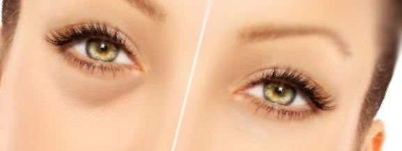 Tear trough filler