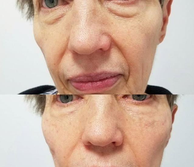 tear trough filler injection