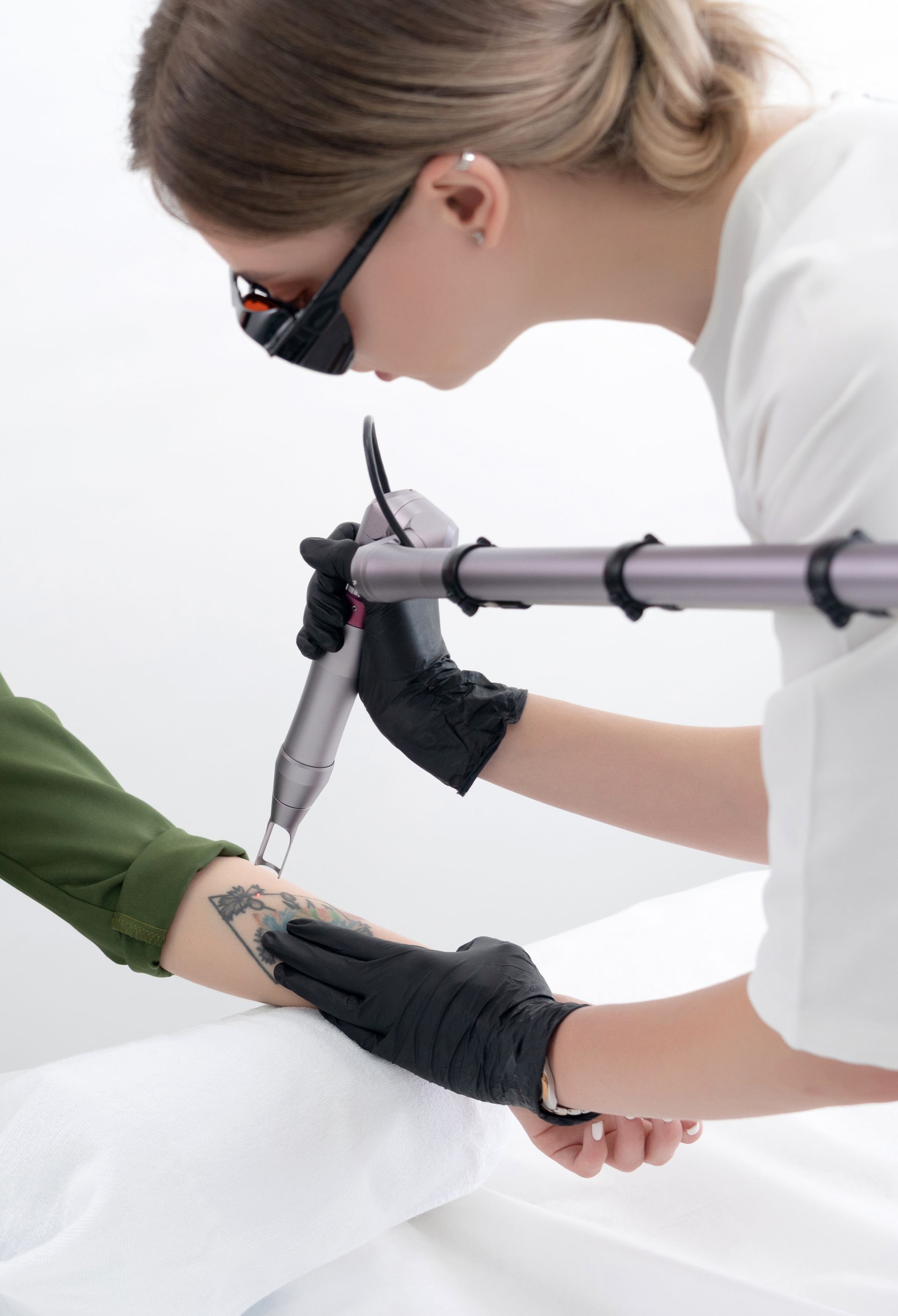 tattoo removal