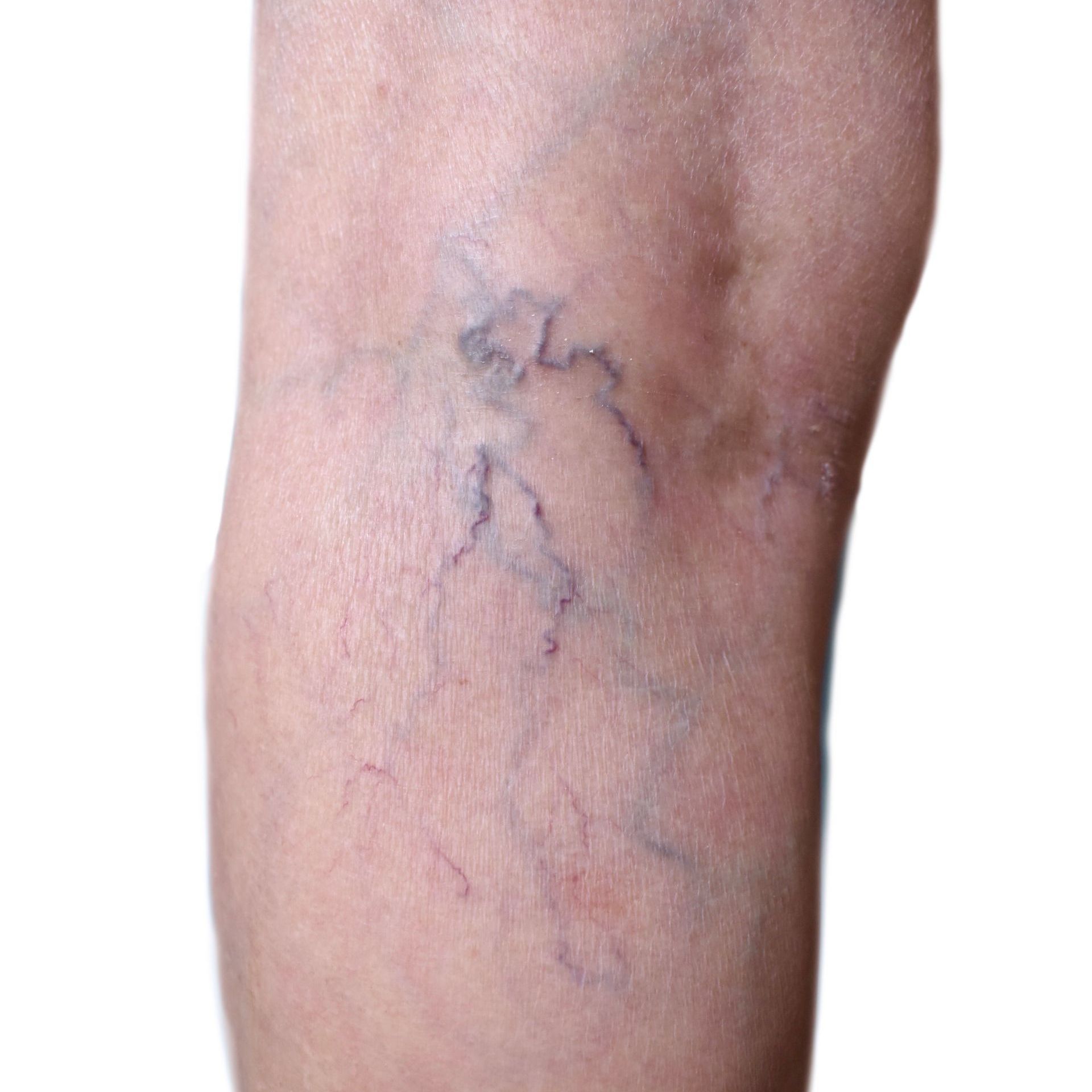 woman with varicose veins