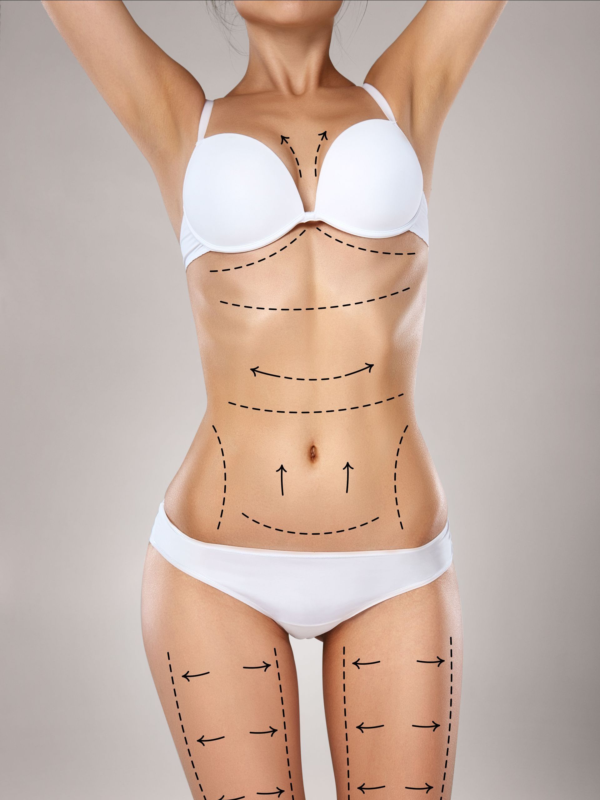 liposuction markings