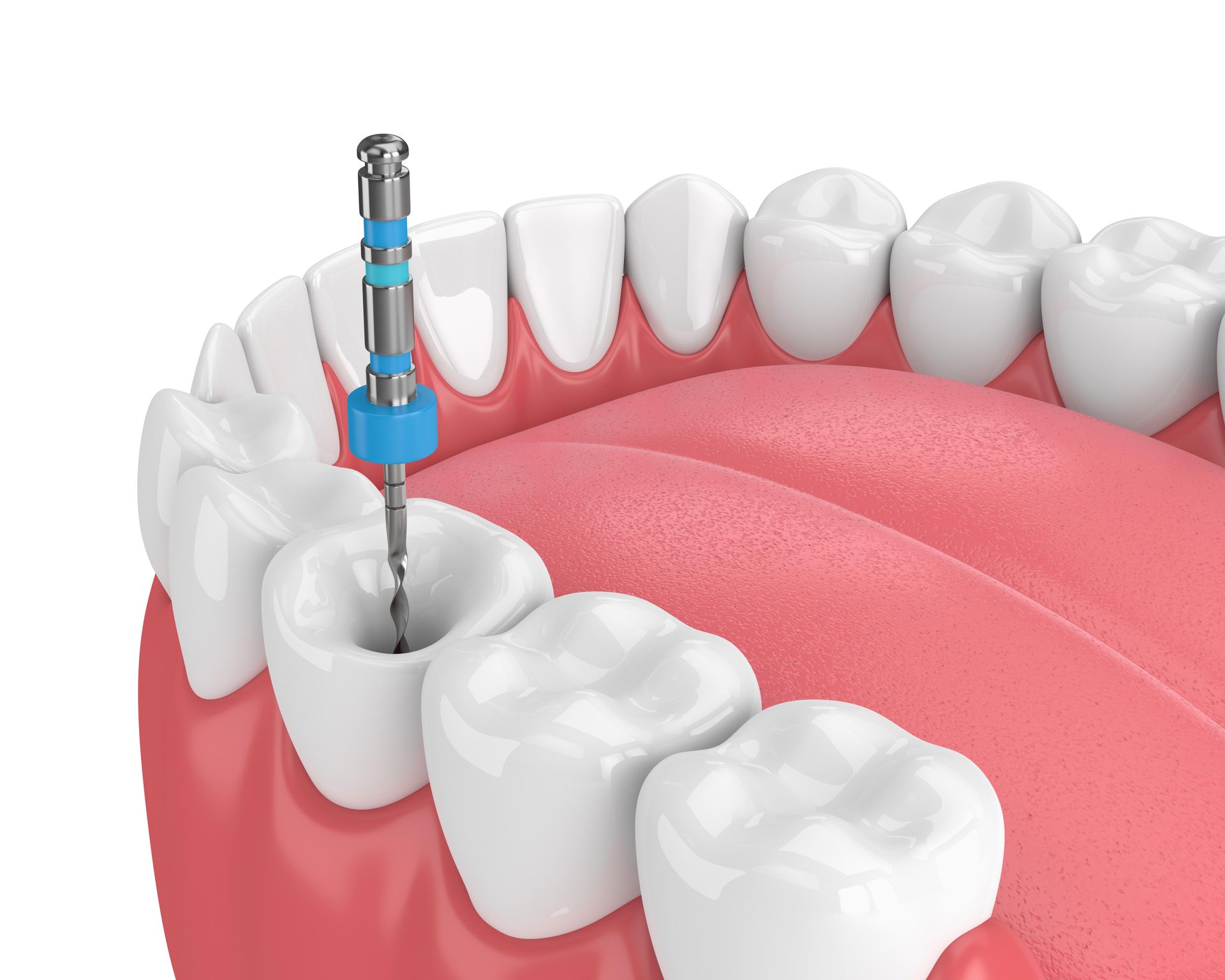 Trapano per impianto dentale inserito nell'alveolo di un molare inferiore, con gengive e denti visibili.
