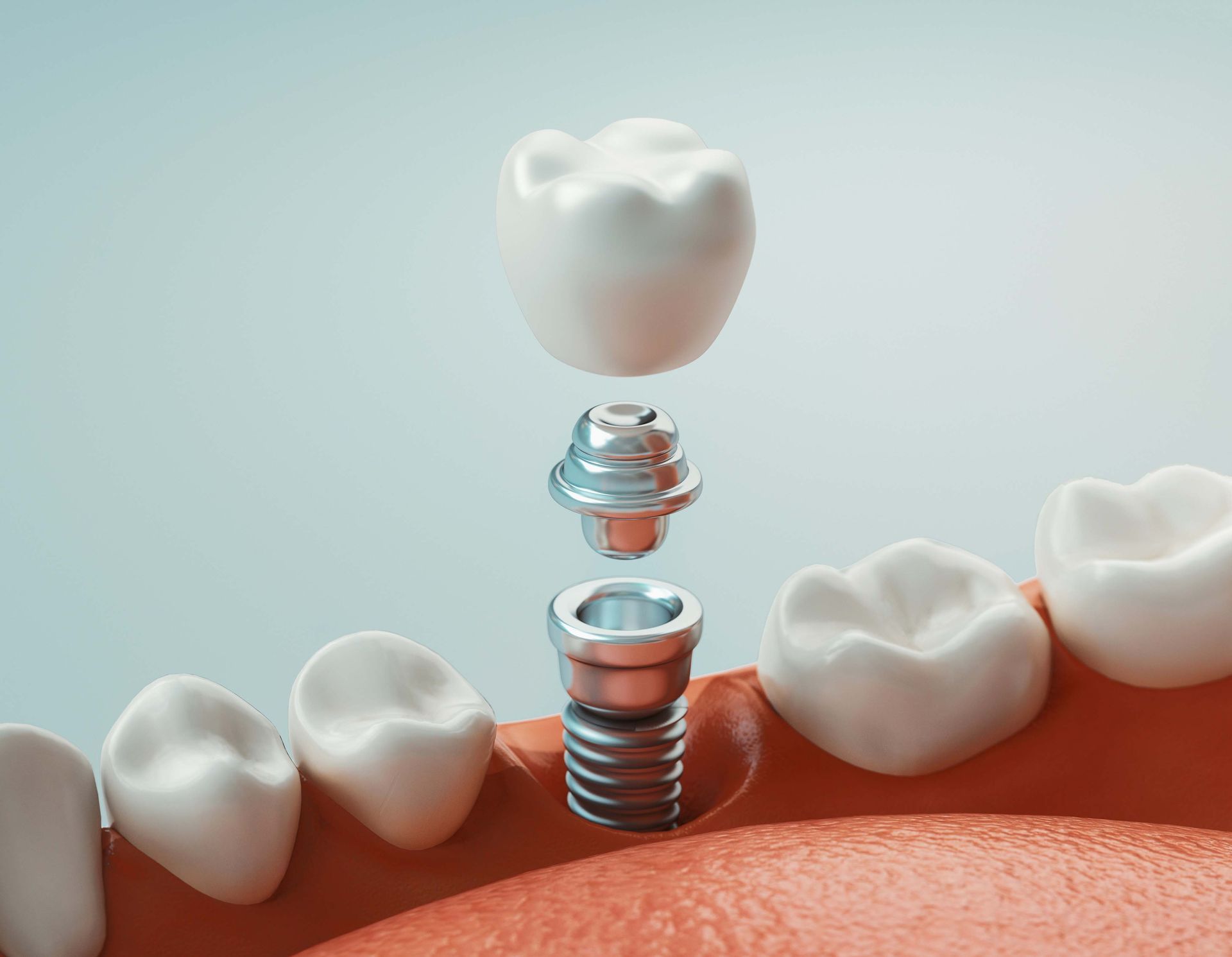 Schema di un impianto dentale con perno e corona in titanio tra denti bianchi e gengive rosa.