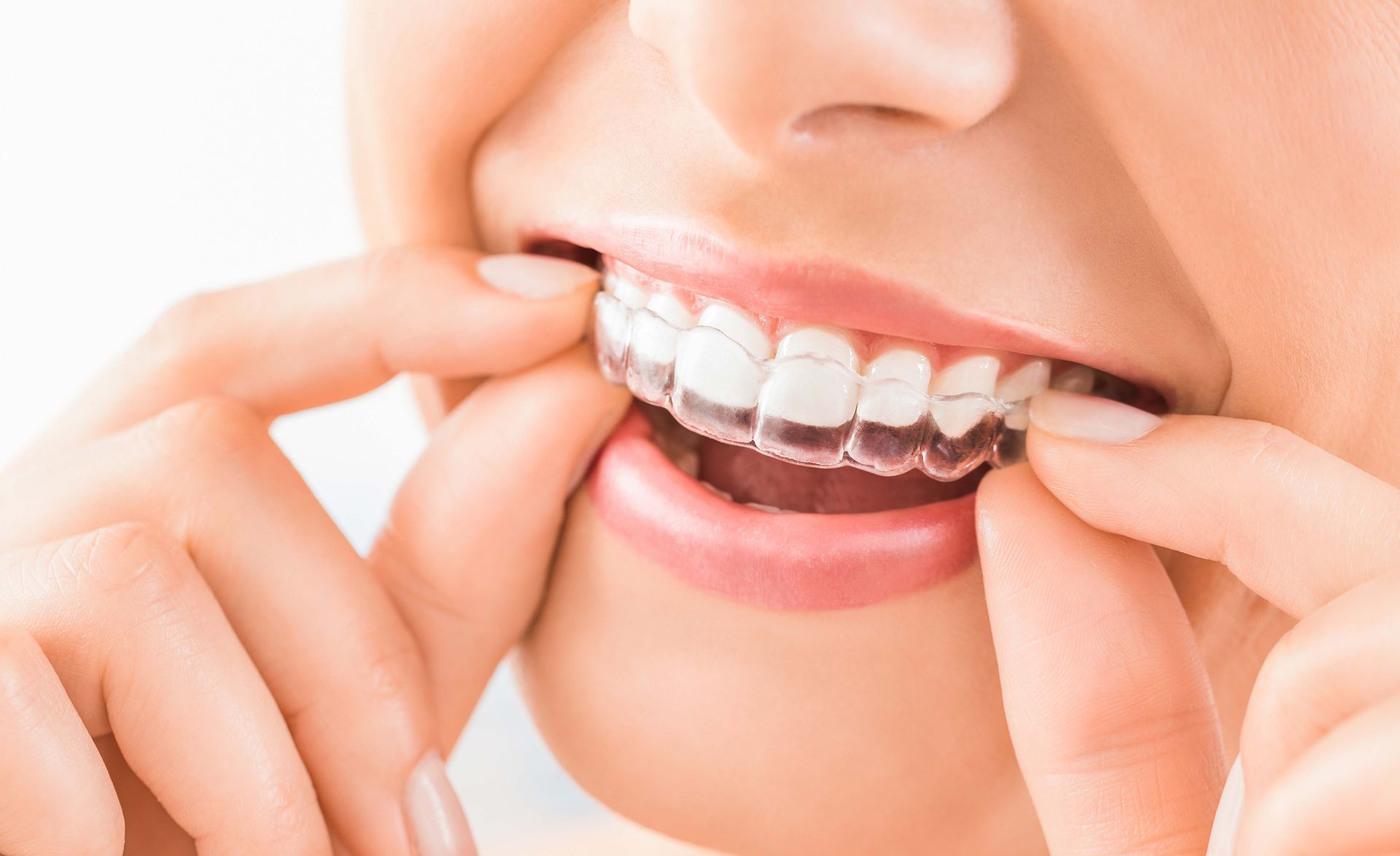 Mani che sistemano un apparecchio ortodontico trasparente su una bocca sorridente
