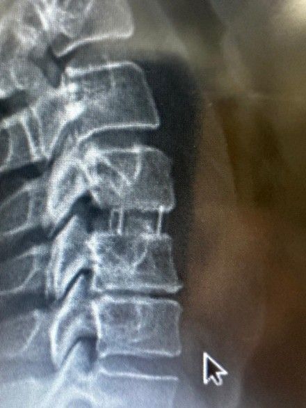 The ACDF surgery was incredible, I felt like I could take on the world