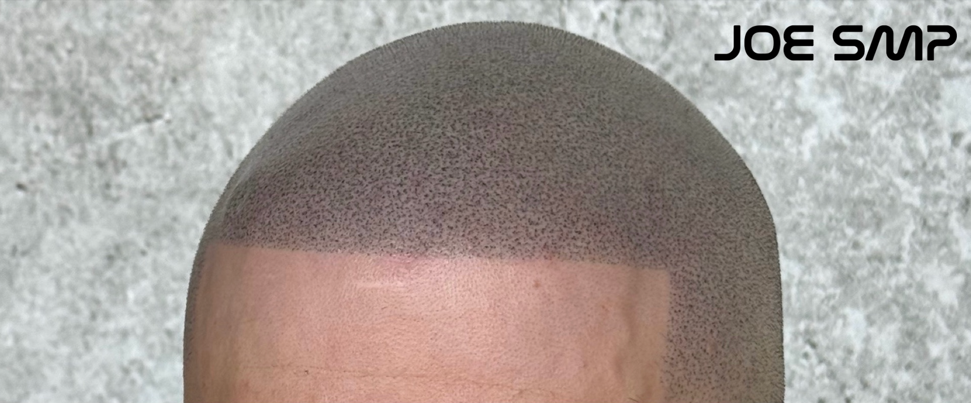 Close-up of a scalp with Scalp Micropigmentation (SMP) to create the appearance of hair. Gray background.
