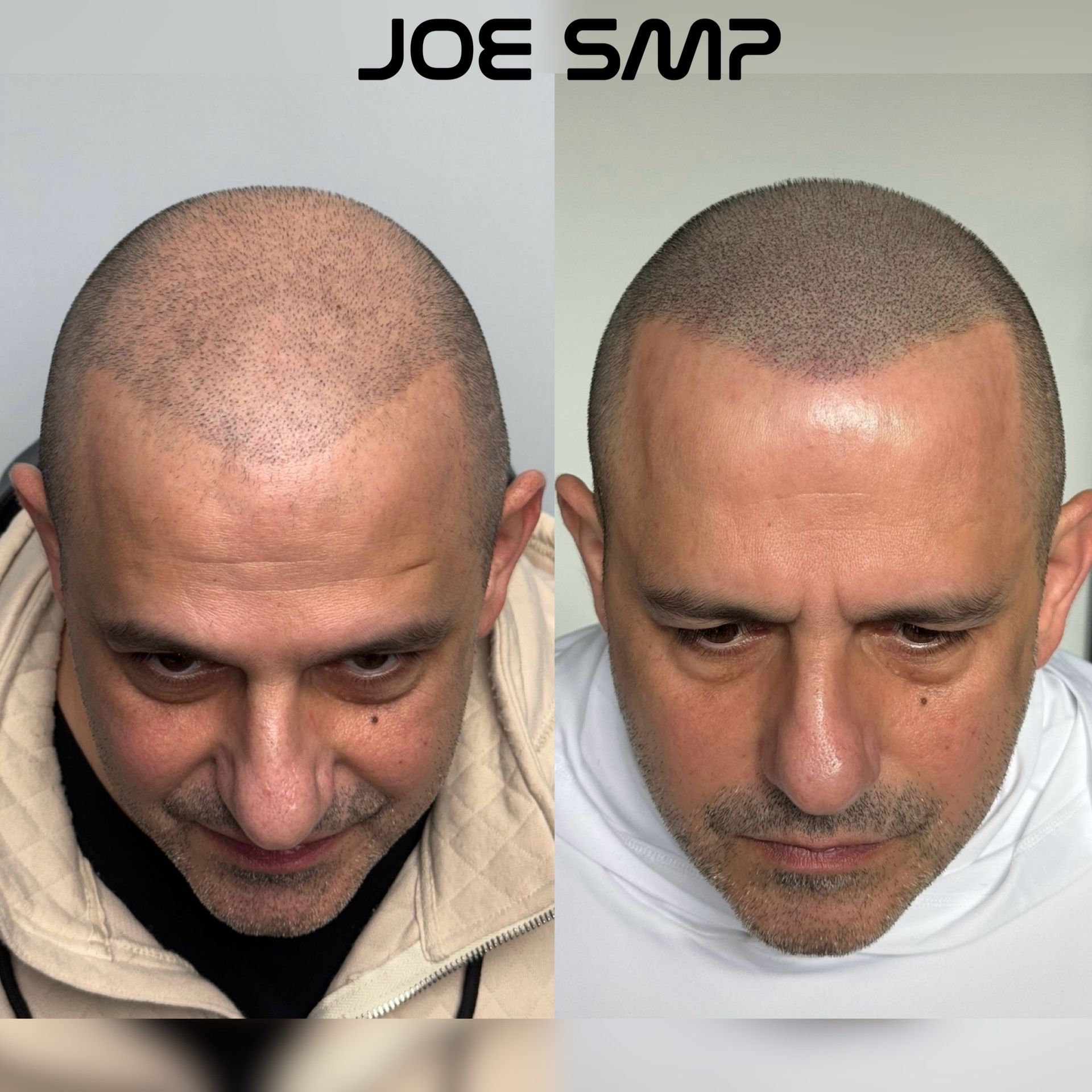 Before and after photos showing scalp micropigmentation on a man, creating the appearance of a shaved head.