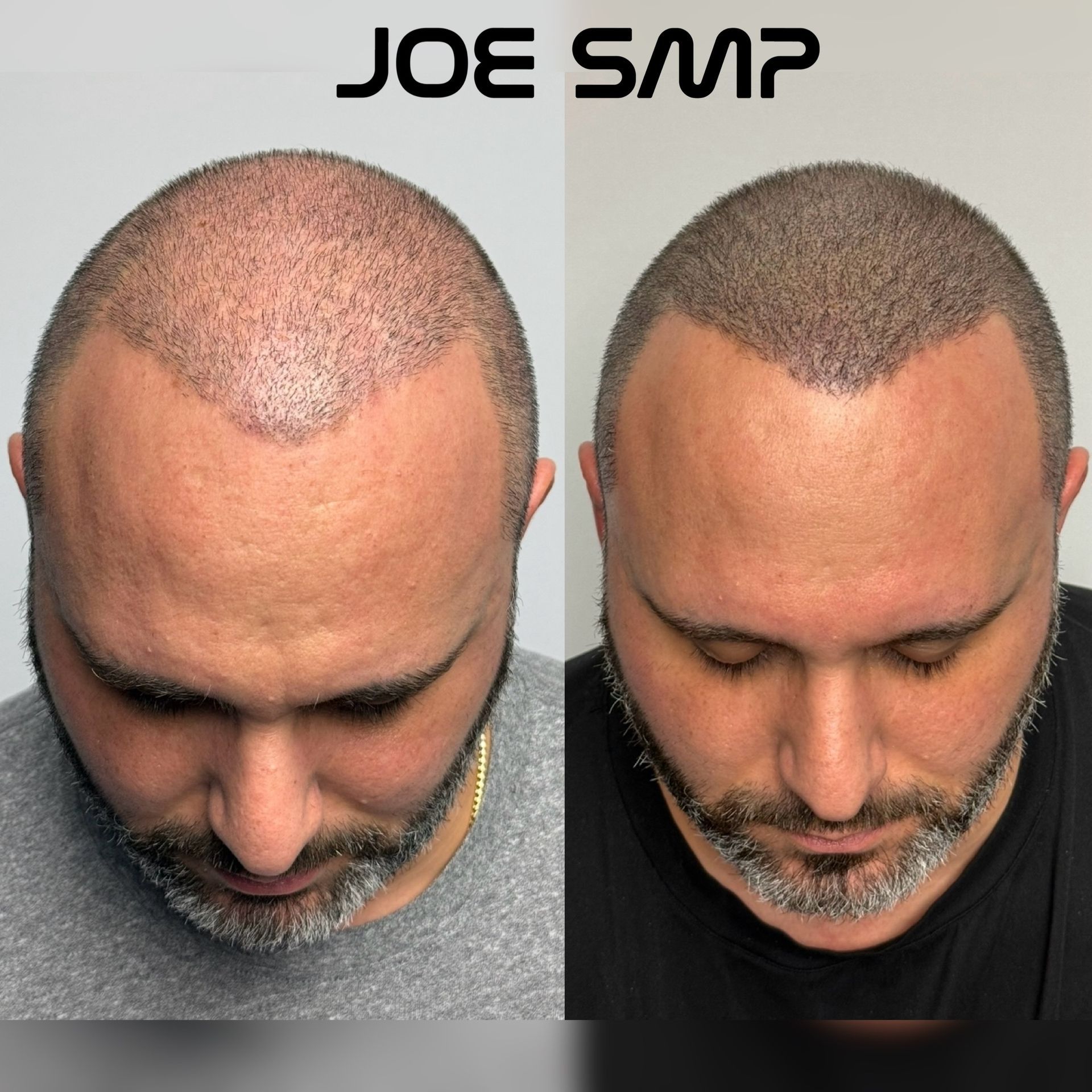 Side-by-side comparison of a man's head before and after Scalp Micropigmentation (SMP) treatment for hair loss.