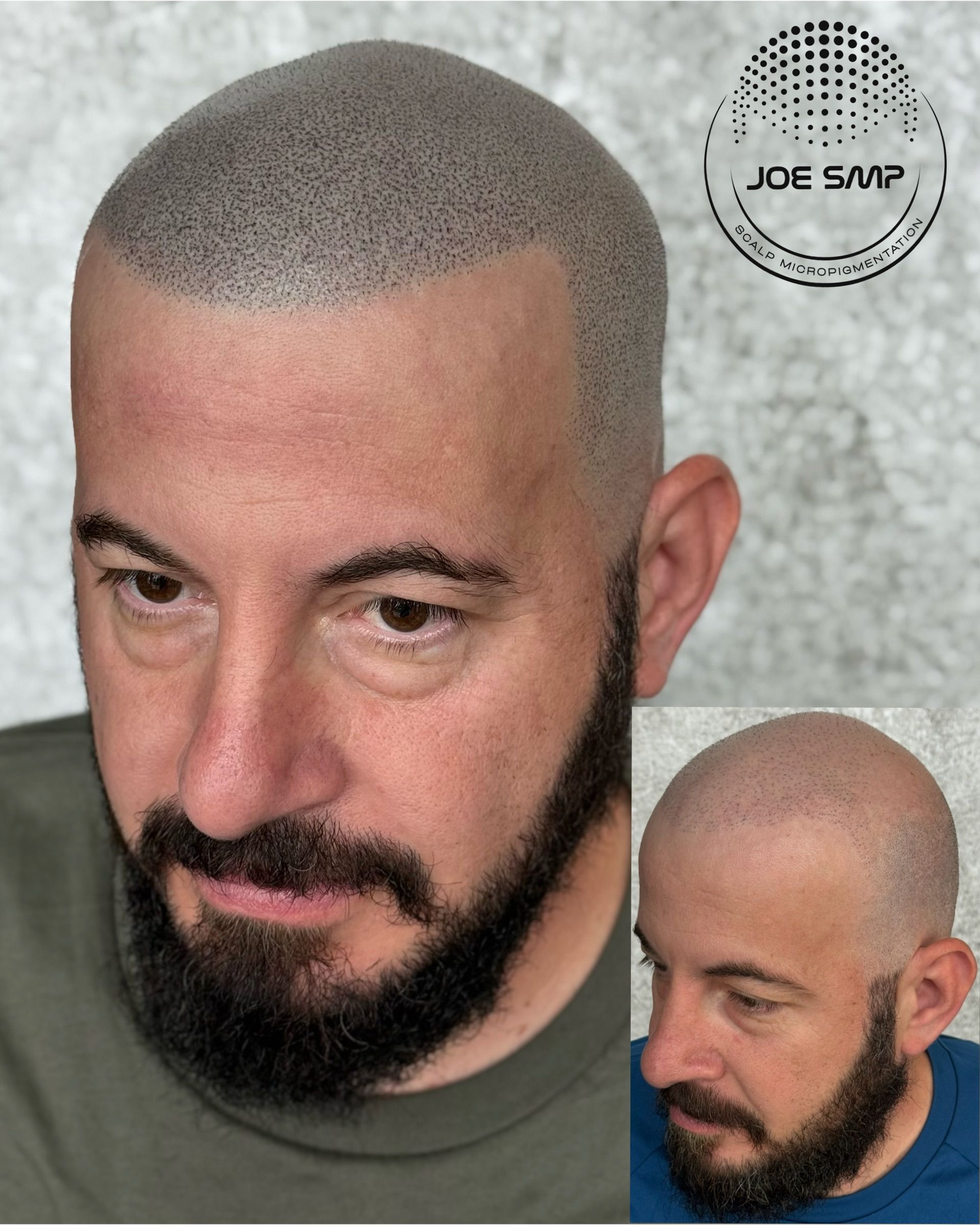 Man with scalp micropigmentation and beard; black dots simulate hair follicles.