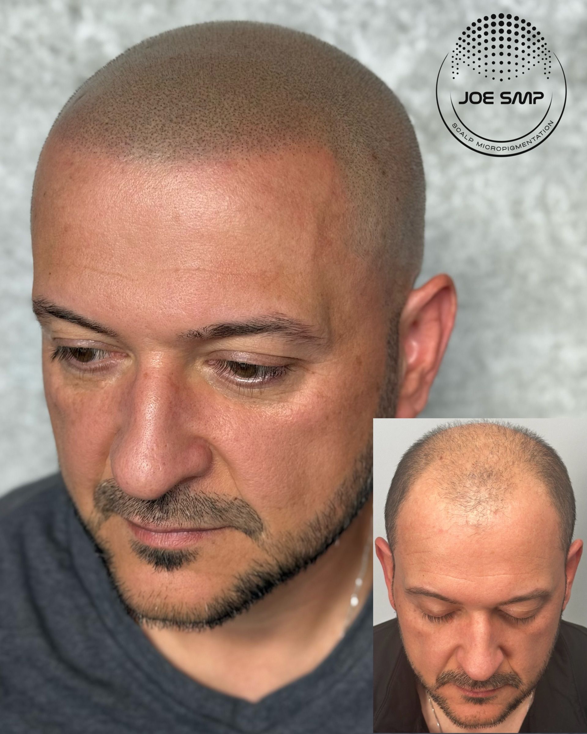 Man with shaved head, before and after Scalp Micropigmentation (SMP) treatment. SMP creates appearance of fuller hair.